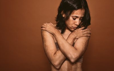 Huidheld Victoria heeft vitiligo